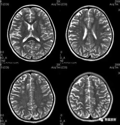 烟雾病(Moyamoya disease)、CT及MRI表现 烟雾病(Moyamoya disease)、CT及MRI表现
