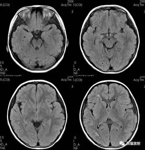 烟雾病(Moyamoya disease)、CT及MRI表现 烟雾病(Moyamoya disease)、CT及MRI表现