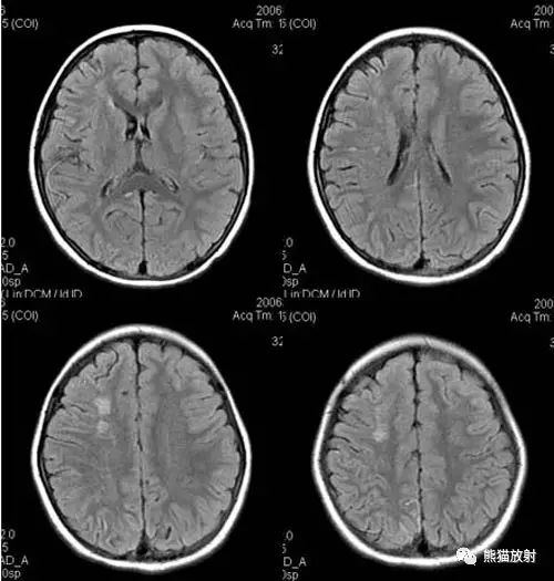 烟雾病(Moyamoya disease)、CT及MRI表现 烟雾病(Moyamoya disease)、CT及MRI表现