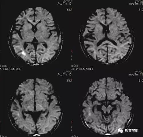 烟雾病(Moyamoya disease)、CT及MRI表现 烟雾病(Moyamoya disease)、CT及MRI表现