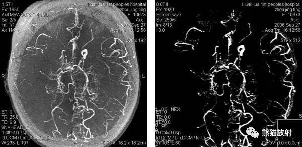 烟雾病(Moyamoya disease)、CT及MRI表现 烟雾病(Moyamoya disease)、CT及MRI表现