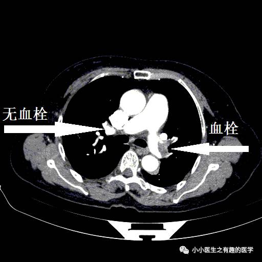 肺栓塞CT轻松入门 肺栓塞CT轻松入门
