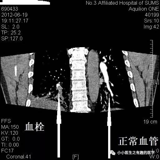 肺栓塞CT轻松入门 肺栓塞CT轻松入门