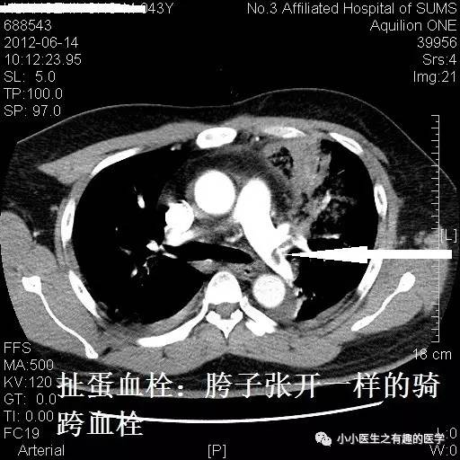 肺栓塞CT轻松入门 肺栓塞CT轻松入门