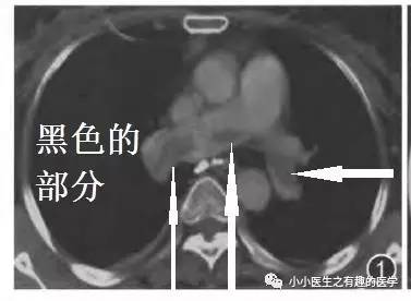 肺栓塞CT轻松入门 肺栓塞CT轻松入门