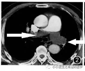 肺栓塞CT轻松入门 肺栓塞CT轻松入门