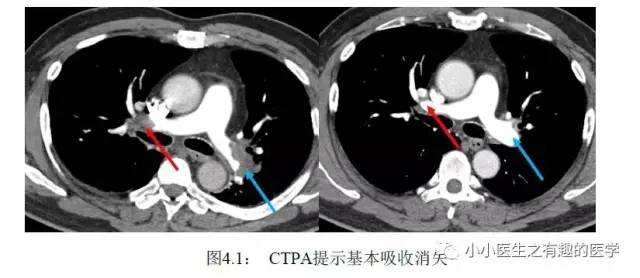 肺栓塞CT轻松入门 肺栓塞CT轻松入门