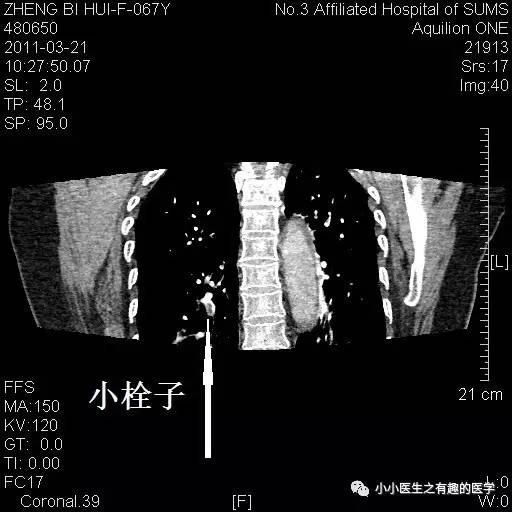 肺栓塞CT轻松入门 肺栓塞CT轻松入门