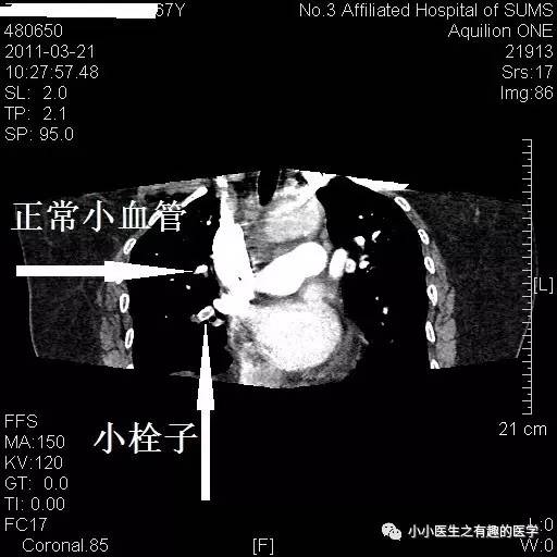肺栓塞CT轻松入门 肺栓塞CT轻松入门