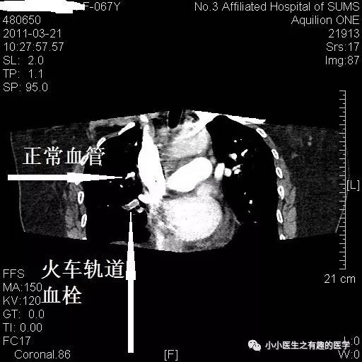 肺栓塞CT轻松入门 肺栓塞CT轻松入门