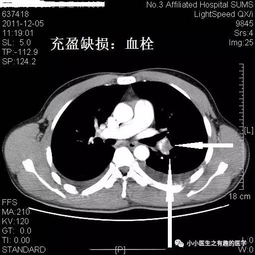 肺栓塞CT轻松入门 肺栓塞CT轻松入门