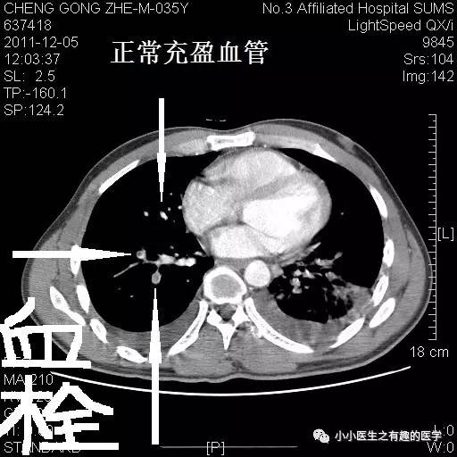 肺栓塞CT轻松入门 肺栓塞CT轻松入门