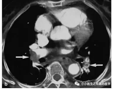 肺栓塞提高篇:CT平扫可发现、甚至诊断肺栓塞,看看国外高手论肺栓塞 肺栓塞提高篇:CT平扫可发现、甚至诊断肺栓塞,看看国外高手论肺栓塞