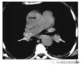 肺栓塞提高篇:CT平扫可发现、甚至诊断肺栓塞,看看国外高手论肺栓塞 肺栓塞提高篇:CT平扫可发现、甚至诊断肺栓塞,看看国外高手论肺栓塞