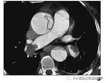 肺栓塞提高篇:CT平扫可发现、甚至诊断肺栓塞,看看国外高手论肺栓塞 肺栓塞提高篇:CT平扫可发现、甚至诊断肺栓塞,看看国外高手论肺栓塞