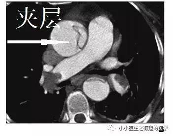 肺栓塞提高篇:CT平扫可发现、甚至诊断肺栓塞,看看国外高手论肺栓塞 肺栓塞提高篇:CT平扫可发现、甚至诊断肺栓塞,看看国外高手论肺栓塞