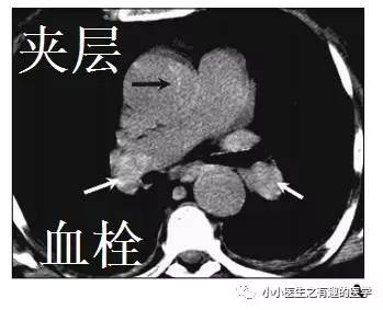 肺栓塞提高篇:CT平扫可发现、甚至诊断肺栓塞,看看国外高手论肺栓塞 肺栓塞提高篇:CT平扫可发现、甚至诊断肺栓塞,看看国外高手论肺栓塞