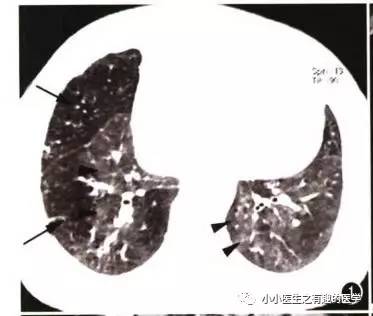 肺栓塞提高篇:CT平扫可发现、甚至诊断肺栓塞,看看国外高手论肺栓塞 肺栓塞提高篇:CT平扫可发现、甚至诊断肺栓塞,看看国外高手论肺栓塞
