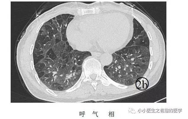 肺栓塞提高篇:CT平扫可发现、甚至诊断肺栓塞,看看国外高手论肺栓塞 肺栓塞提高篇:CT平扫可发现、甚至诊断肺栓塞,看看国外高手论肺栓塞