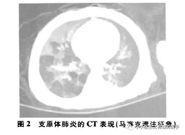 肺栓塞提高篇:CT平扫可发现、甚至诊断肺栓塞,看看国外高手论肺栓塞 肺栓塞提高篇:CT平扫可发现、甚至诊断肺栓塞,看看国外高手论肺栓塞