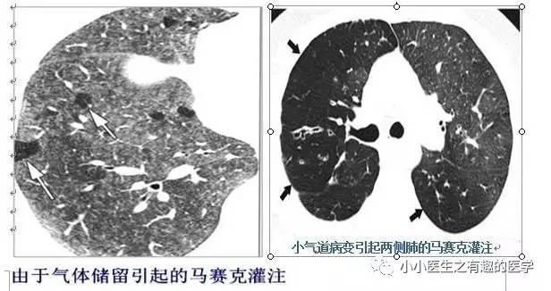 肺栓塞提高篇:CT平扫可发现、甚至诊断肺栓塞,看看国外高手论肺栓塞 肺栓塞提高篇:CT平扫可发现、甚至诊断肺栓塞,看看国外高手论肺栓塞