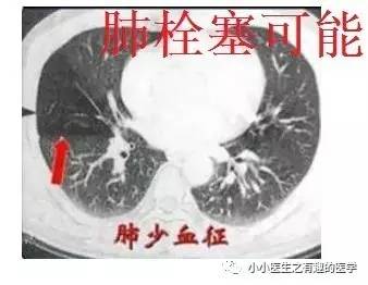 肺栓塞提高篇:CT平扫可发现、甚至诊断肺栓塞,看看国外高手论肺栓塞 肺栓塞提高篇:CT平扫可发现、甚至诊断肺栓塞,看看国外高手论肺栓塞
