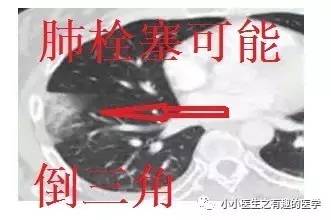 肺栓塞提高篇:CT平扫可发现、甚至诊断肺栓塞,看看国外高手论肺栓塞 肺栓塞提高篇:CT平扫可发现、甚至诊断肺栓塞,看看国外高手论肺栓塞