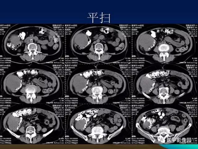 【病例】升结肠神经内分泌肿瘤1例CT影像表现 【病例】升结肠神经内分泌肿瘤1例CT影像表现