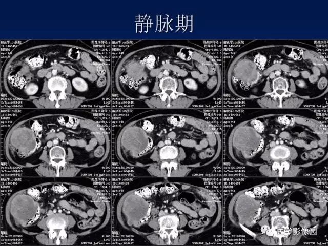【病例】升结肠神经内分泌肿瘤1例CT影像表现 【病例】升结肠神经内分泌肿瘤1例CT影像表现