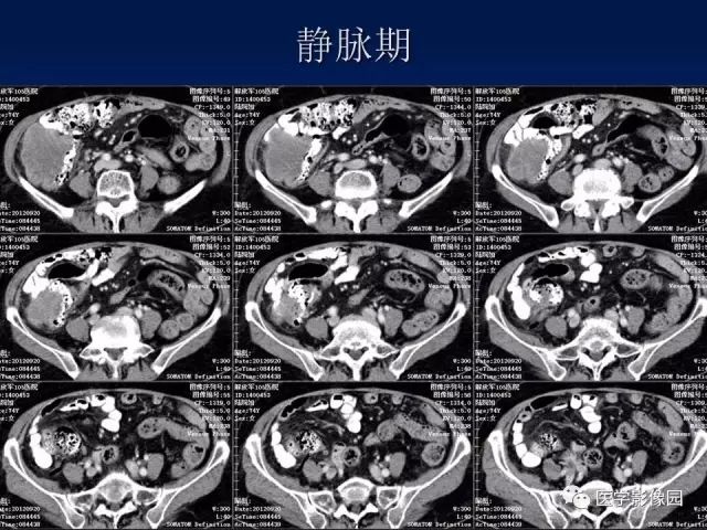 【病例】升结肠神经内分泌肿瘤1例CT影像表现 【病例】升结肠神经内分泌肿瘤1例CT影像表现