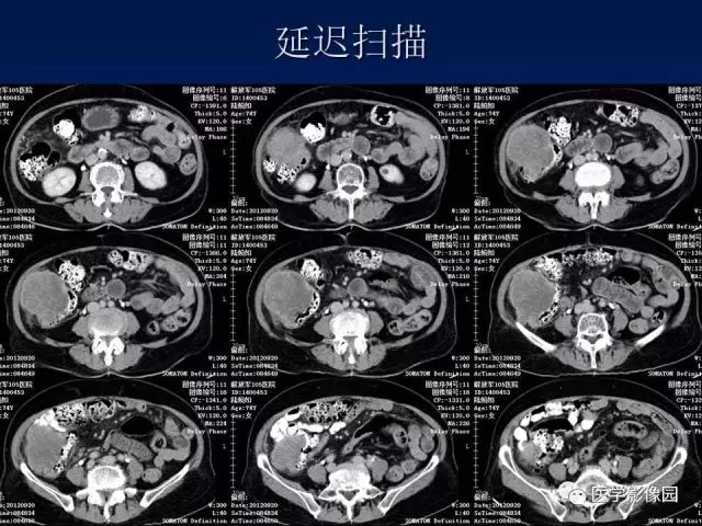 【病例】升结肠神经内分泌肿瘤1例CT影像表现 【病例】升结肠神经内分泌肿瘤1例CT影像表现