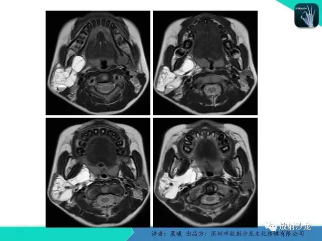 【病例】腮腺淋巴管瘤1例MR
