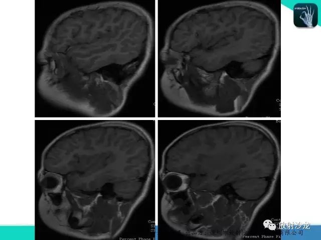 【病例】腮腺淋巴管瘤1例MR