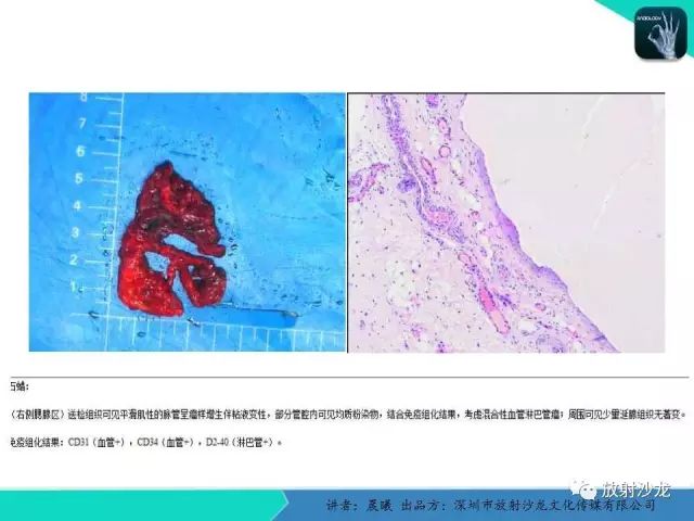 【病例】腮腺淋巴管瘤1例MR