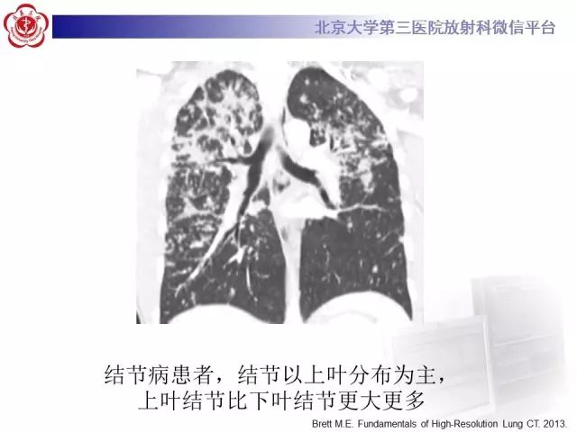 【PPT】(肺)结节(影像诊断)