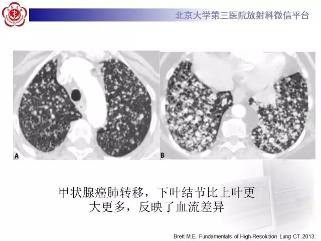 【PPT】(肺)结节(影像诊断)