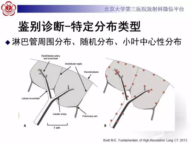 【PPT】(肺)结节(影像诊断)