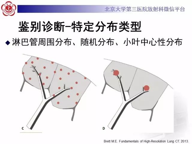 【PPT】(肺)结节(影像诊断)