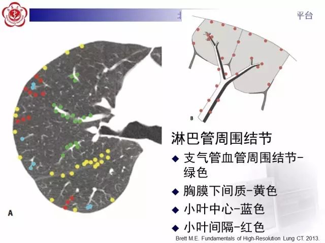 【PPT】(肺)结节(影像诊断)