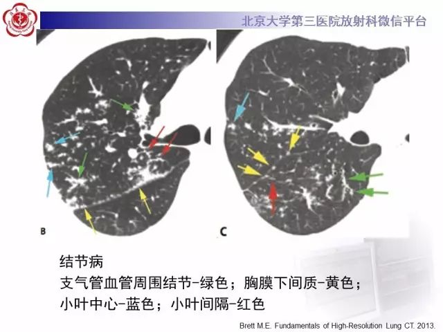 【PPT】(肺)结节(影像诊断)
