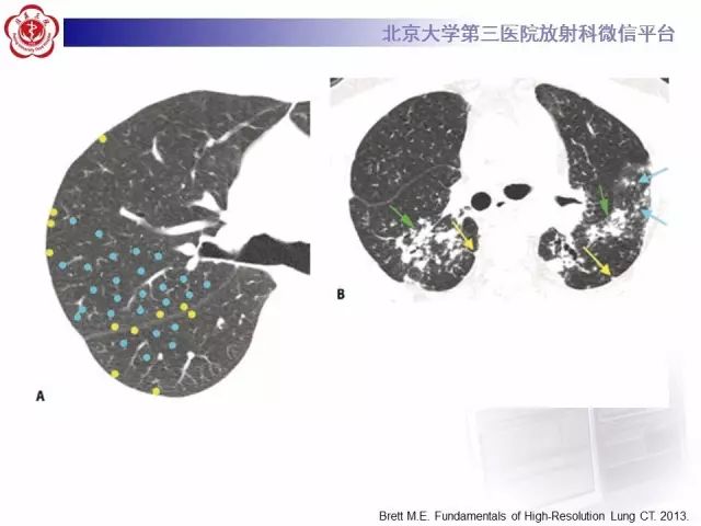 【PPT】(肺)结节(影像诊断)