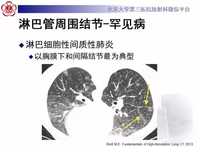 【PPT】(肺)结节(影像诊断)