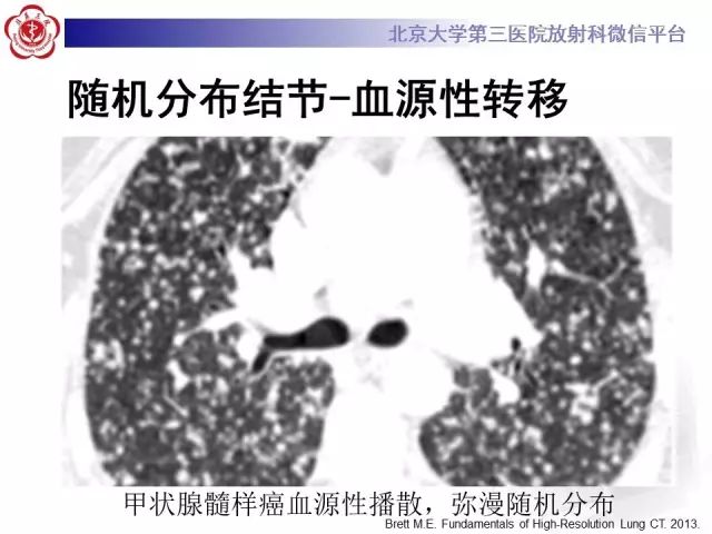 【PPT】(肺)结节(影像诊断)