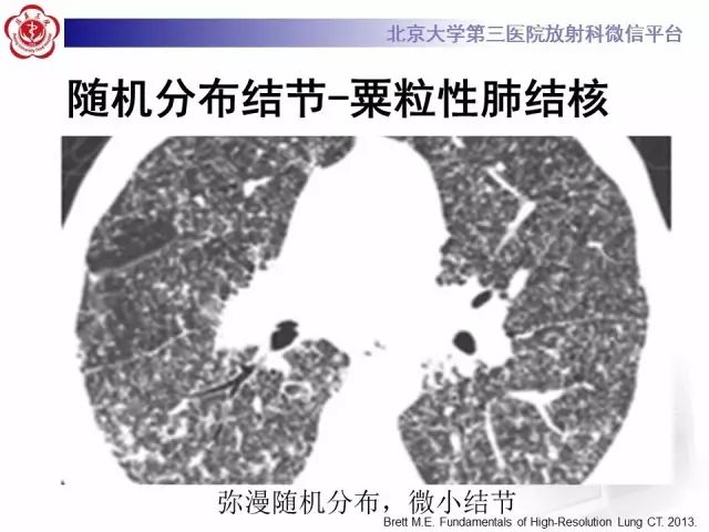 【PPT】(肺)结节(影像诊断)