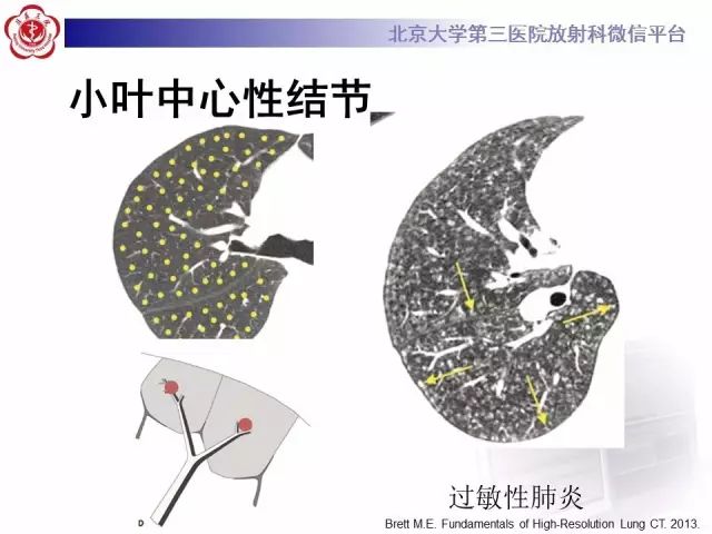 【PPT】(肺)结节(影像诊断)