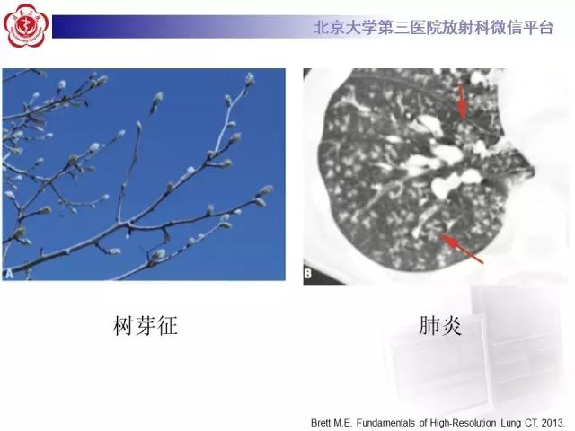 【PPT】(肺)结节(影像诊断)