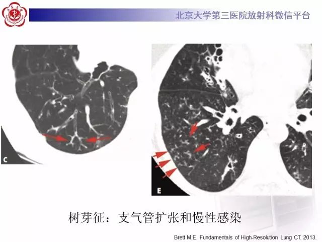 【PPT】(肺)结节(影像诊断)
