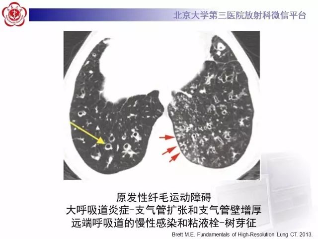 【PPT】(肺)结节(影像诊断)