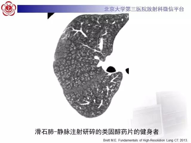 【PPT】(肺)结节(影像诊断)