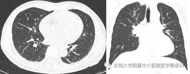 【病例】肝淋巴瘤1例CT影像表现 【病例】肝淋巴瘤1例CT影像表现